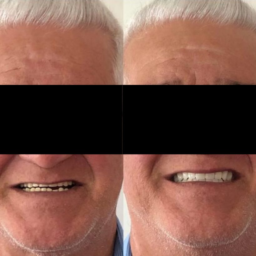 Foto Tratamento - Prótese-01