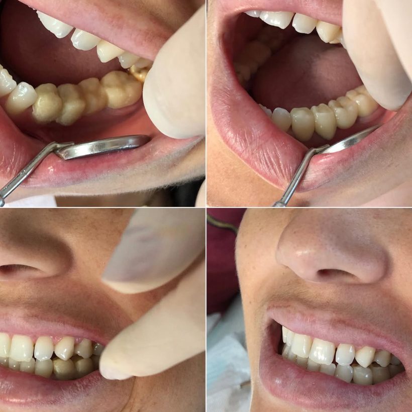 Fotos Tratamento-Prótese 04