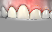 Gengivoplastia - ARTEODONTO CLINICA