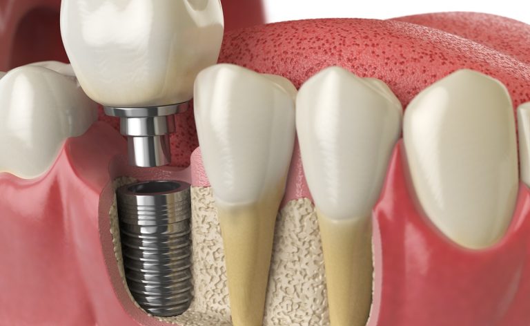 Anatomy of healthy teeth and tooth dental implant in human dentura. 3d illustration