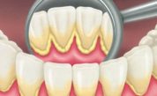 Periodontia Tártaro - ARTEODONTO CLINICA