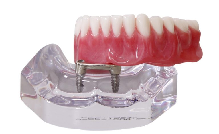 Prótese overdenture - ARTEODONTO CLINICA