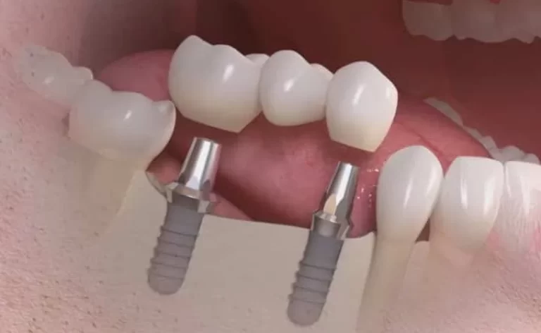 implante dentário múltiplo - ARTEODONTO CLINICA-1