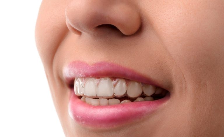 invisalign-vs-ortodontia